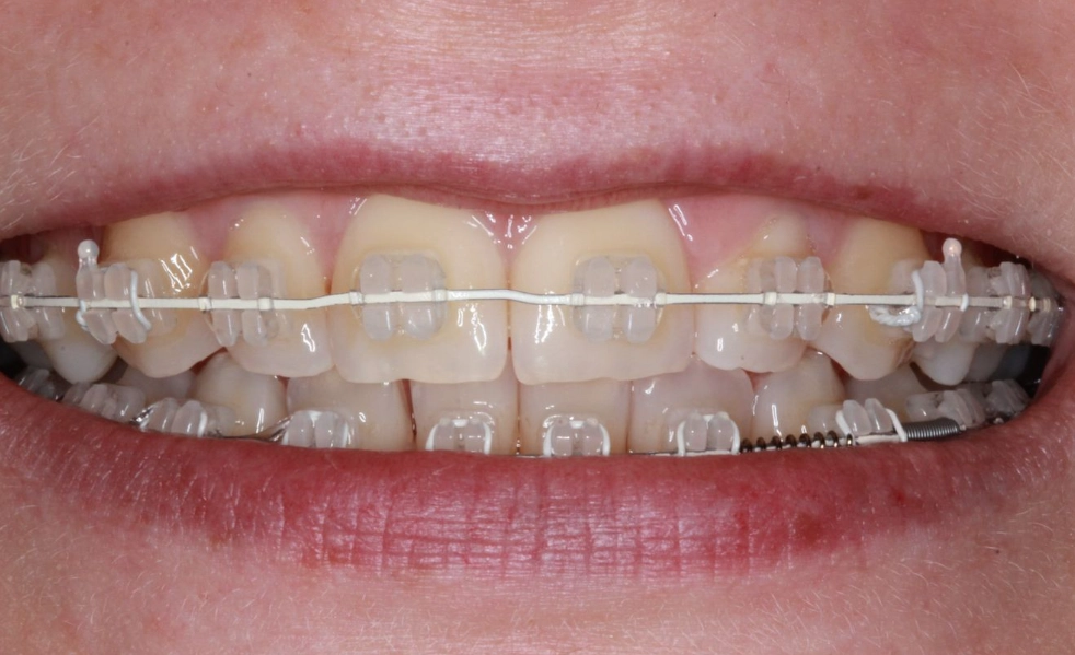 Ceramic Braces: A Complete Guide to Clear Orthodontic Treatment