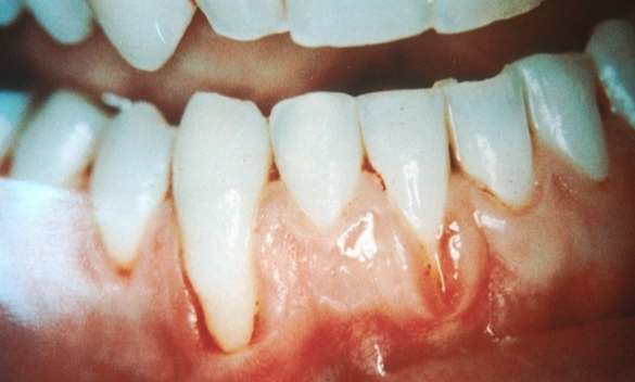 Reverse Gum Recession: What Actually Works & What Doesn't