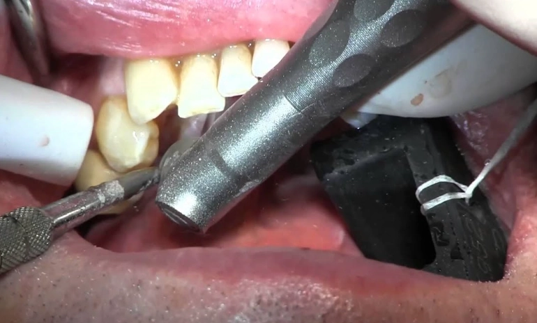 dental tori treatment dental tori treatment