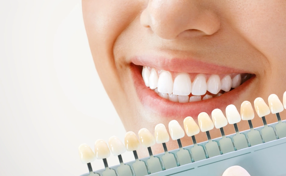 teeth whitening methods