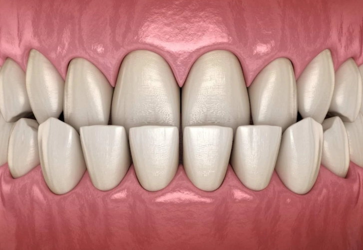 underbite surgery underbite surgery