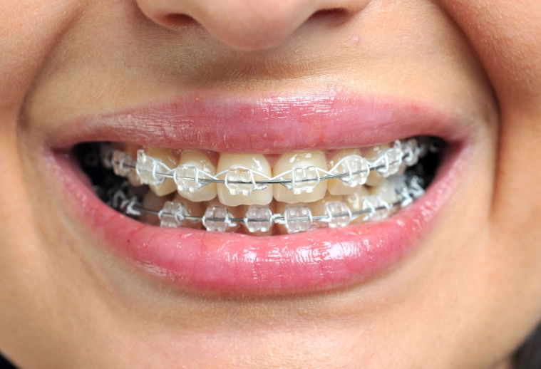 types of braces
