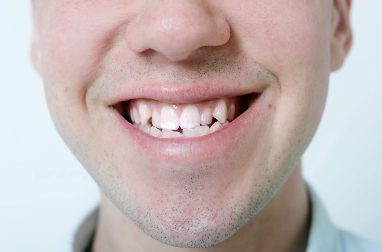 underbite surgery underbite surgery