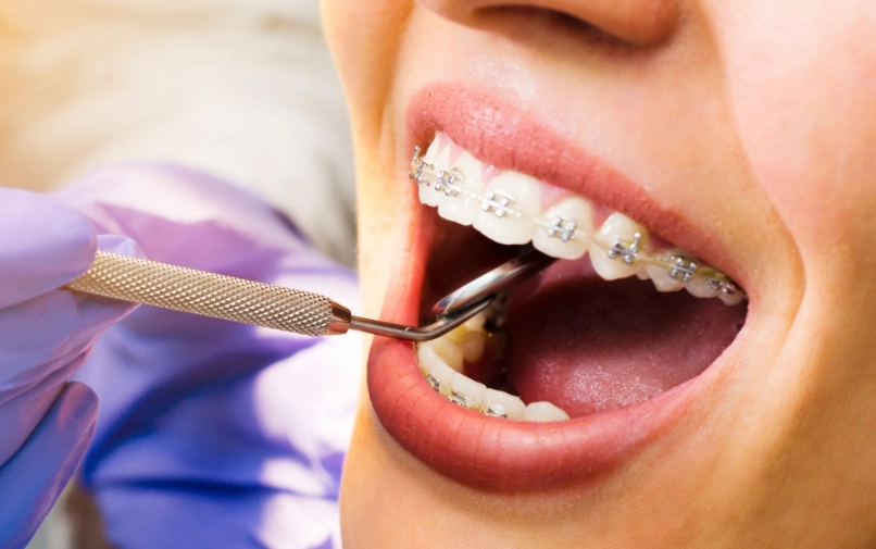 Braces on Teeth: Your Complete Guide to Types, Costs & What to Expect