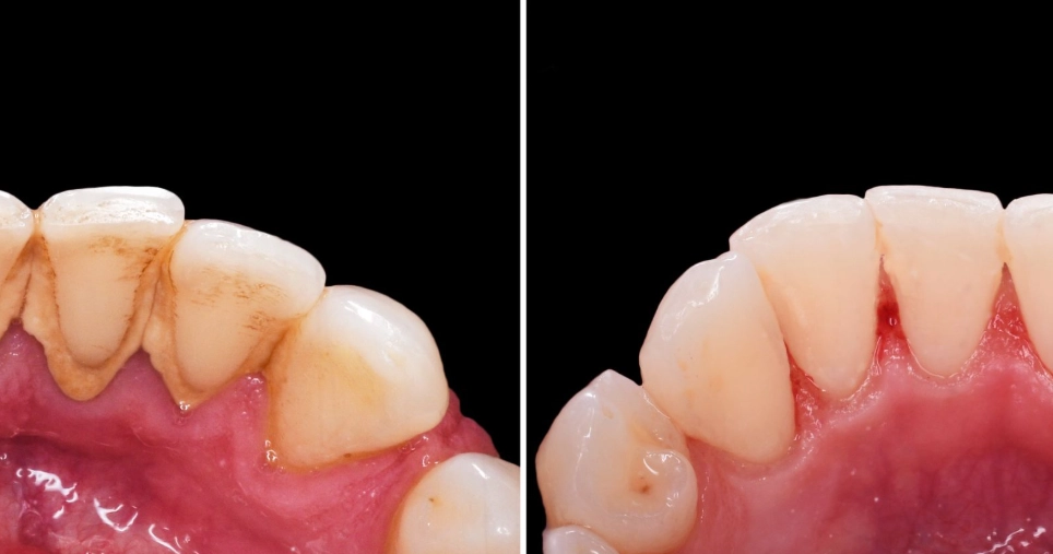 gentle teeth cleaning