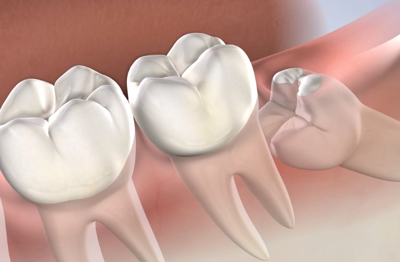 wisdom teeth recovery day 7