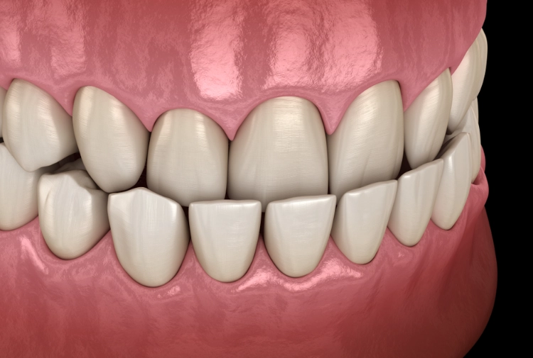 Underbite Explained: Causes, Treatments, and Your Complete Guide
