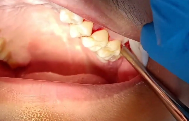 Day 7 Wisdom Teeth Removal: Your Recovery Milestone Guide