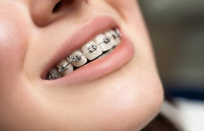 how much do braces cost