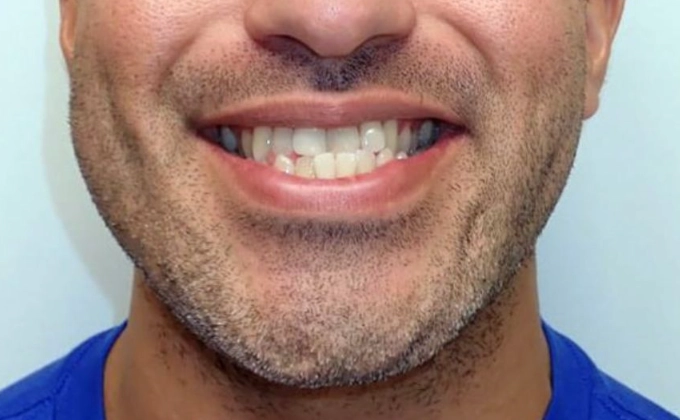 underbite correction underbite correction