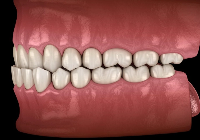 underbite treatment underbite treatment