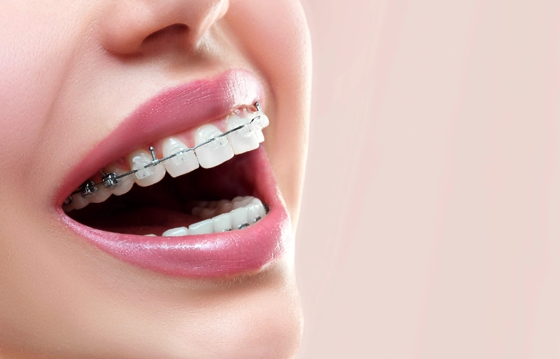 how much do braces cost