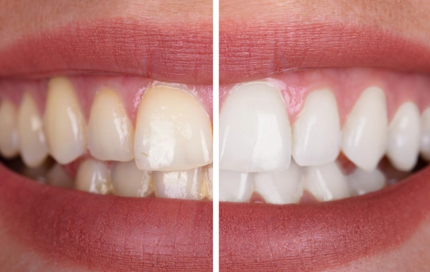 sensitive teeth cleaning