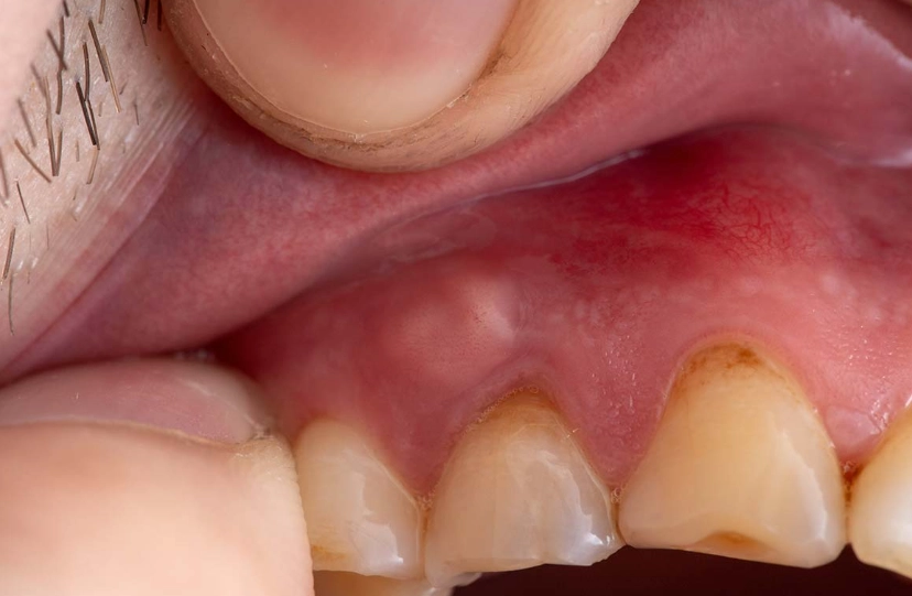 periapical abscess vs periodontal abscess periapical abscess vs periodontal abscess