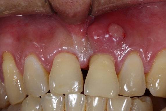 dental abscess icd 10