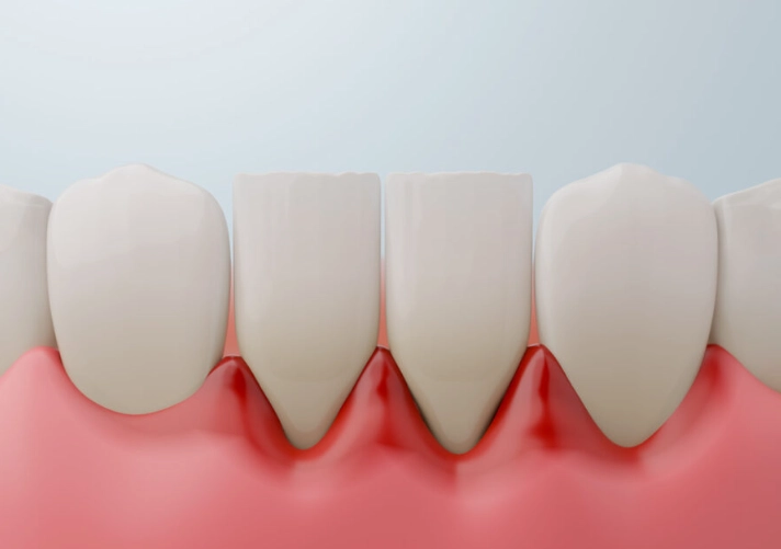 dental abscess types dental abscess types