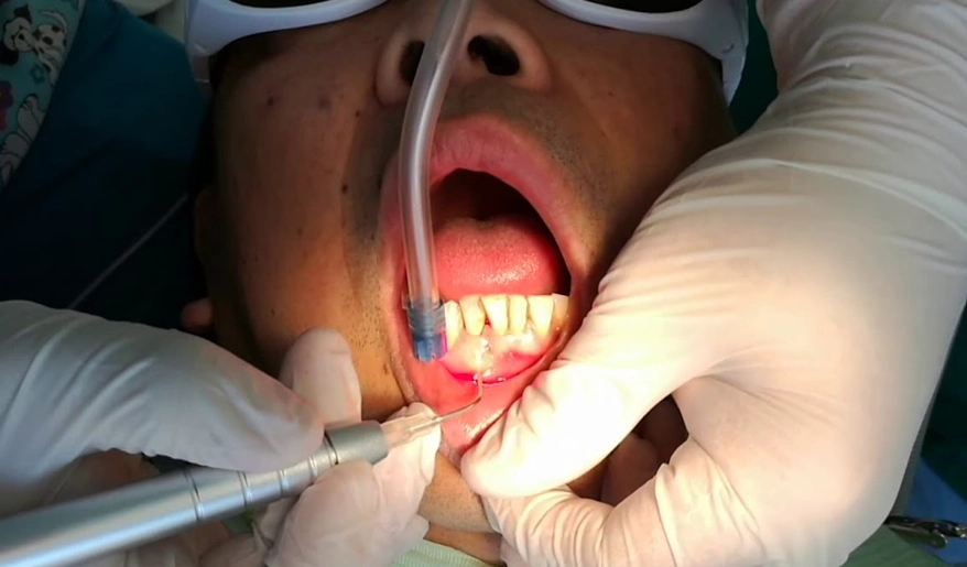 tooth abscess treatment