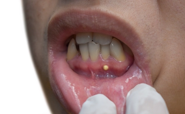 tooth abscess diagnosis code