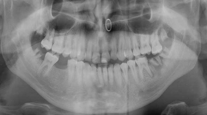 Periapical Abscess CT Scan: Diagnosis, Benefits & What to Expect