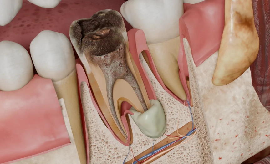 Periapical Abscess Antibiotics: When You Need Them & Which Work Best