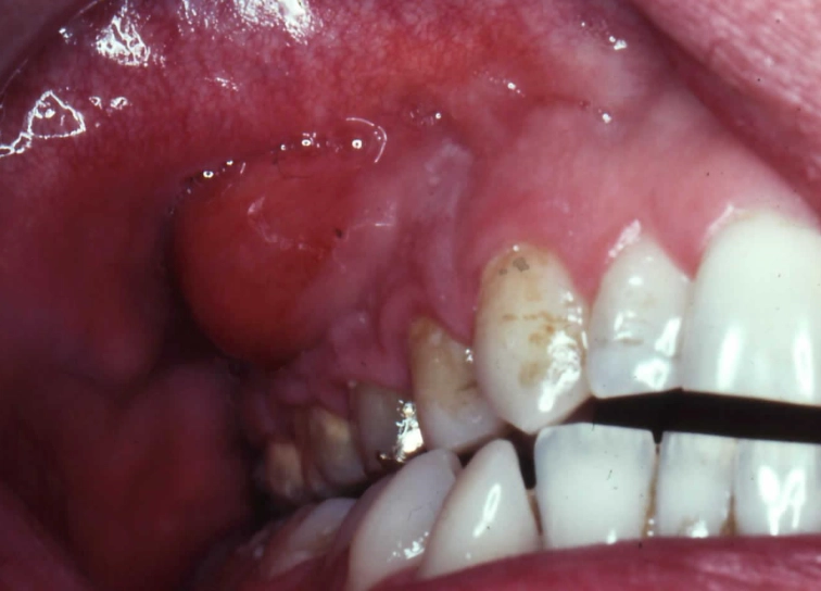 tooth abscess signs tooth abscess signs