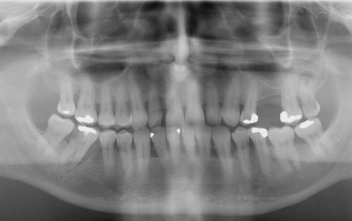 dental abscess symptoms dental abscess symptoms