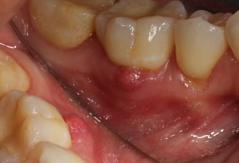 Periapical Abscess with Sinus: Symptoms, Treatment, and Your FAQs