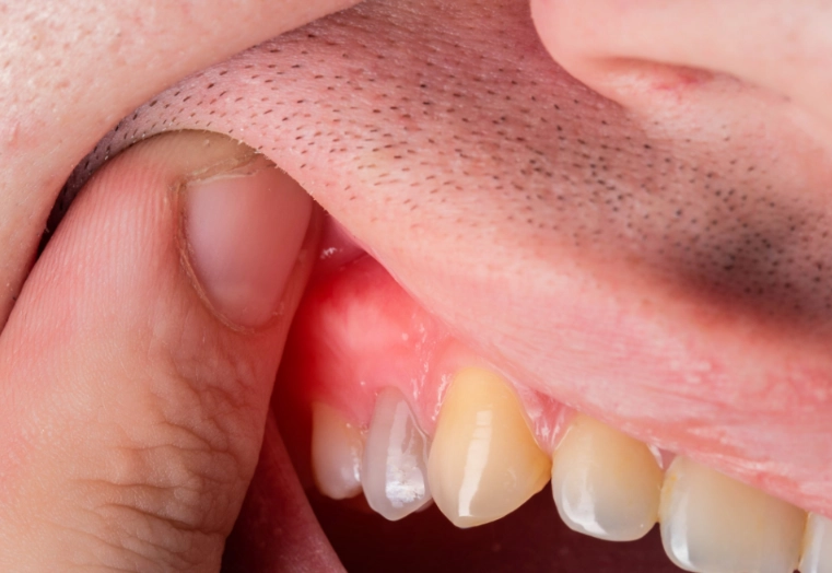 dental infection seriousness