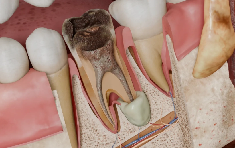 root canal imaging