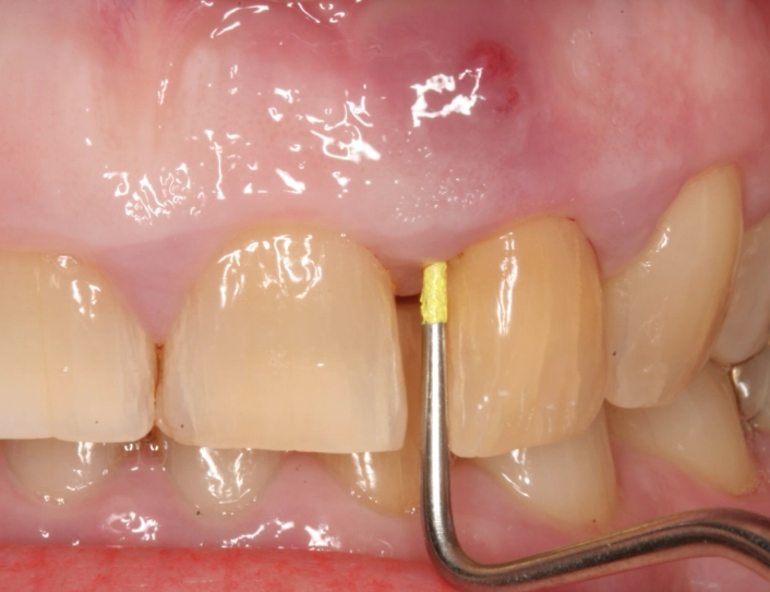 tooth abscess signs tooth abscess signs