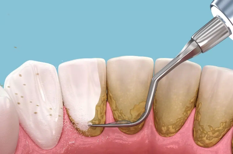 scaling and root planing reviews scaling and root planing reviews