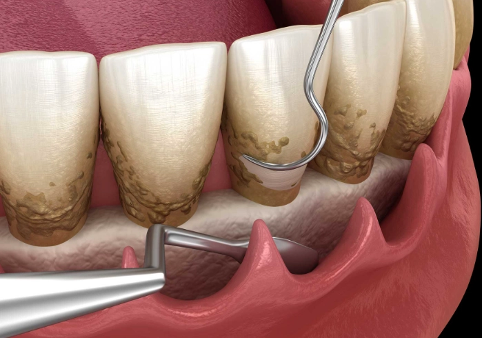 how gums heal after scaling and root planing