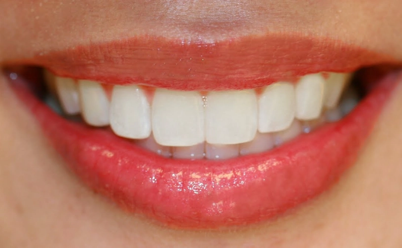 fast teeth whitening at home fast teeth whitening at home