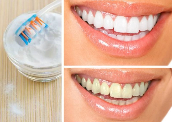 home teeth whitening kits home teeth whitening kits