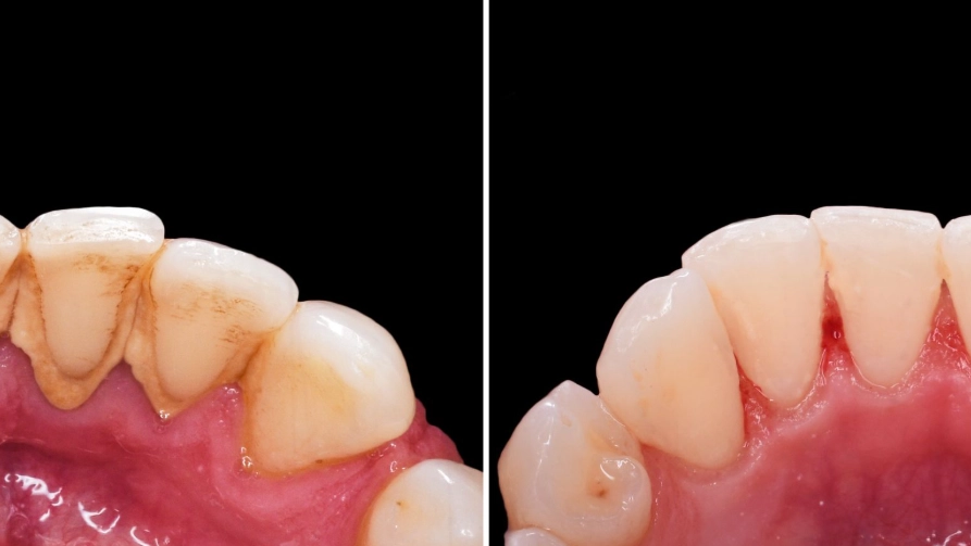 gum disease treatment