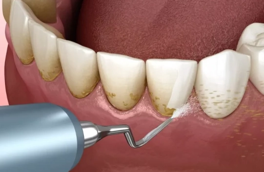 deep gum cleaning pain