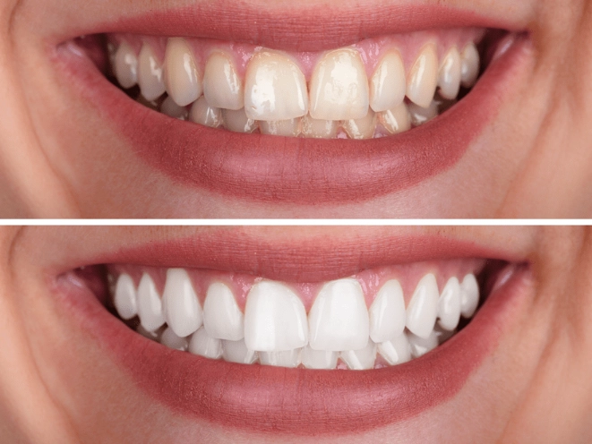 home teeth whitening kits home teeth whitening kits