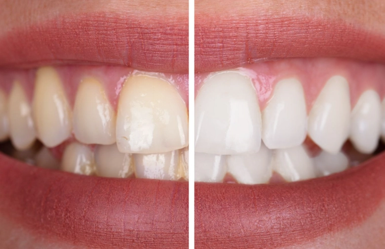 scaling and root planing reviews scaling and root planing reviews