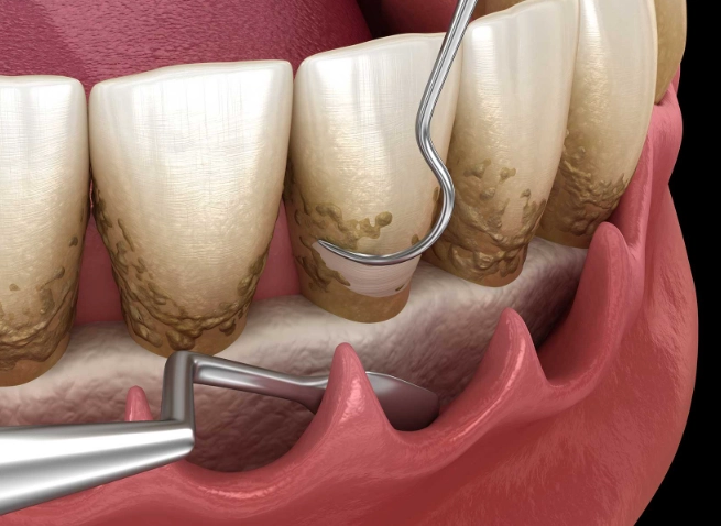 deep teeth cleaning reviews deep teeth cleaning reviews