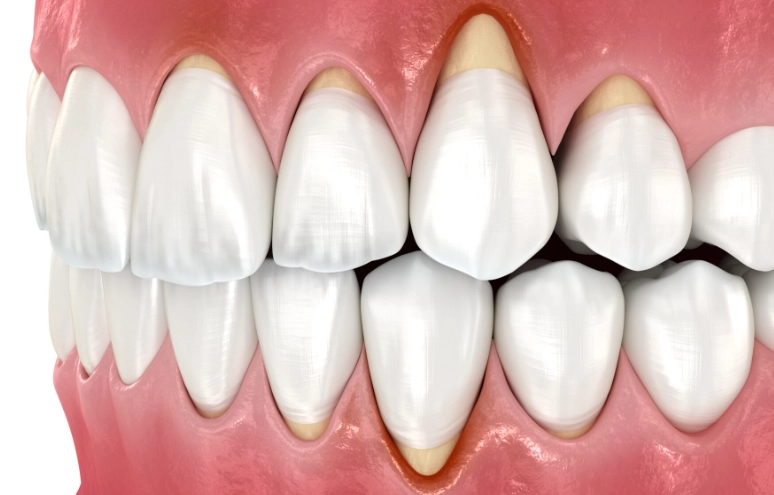 Does Deep Cleaning Help Gum Recession? A Dentist's Honest Guide