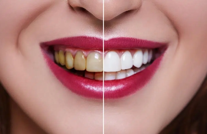What Happens to Your Gums After a Deep Cleaning: Recovery Guide