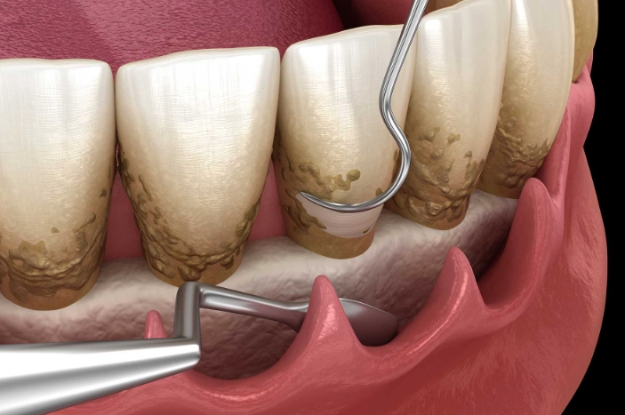 scaling and root planing