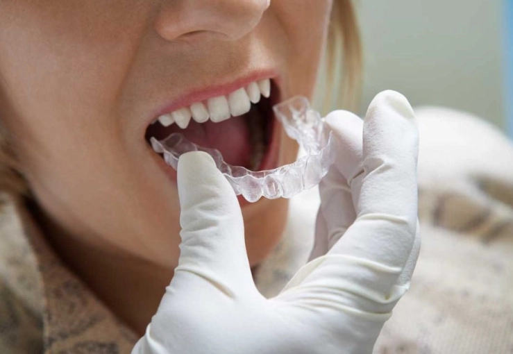 teeth grinding mouth guard teeth grinding mouth guard