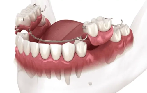 cost of dentures in Alabama