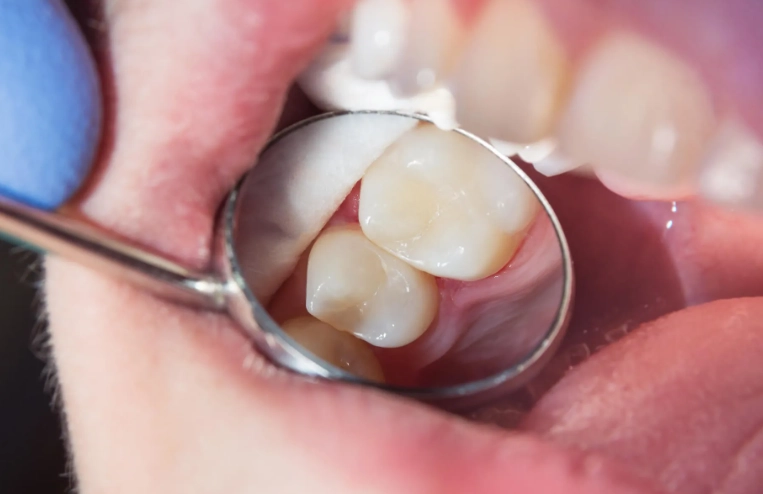 jaw pain 1 week after filling jaw pain 1 week after filling