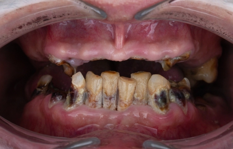 how long for tooth infection to abscess how long for tooth infection to abscess