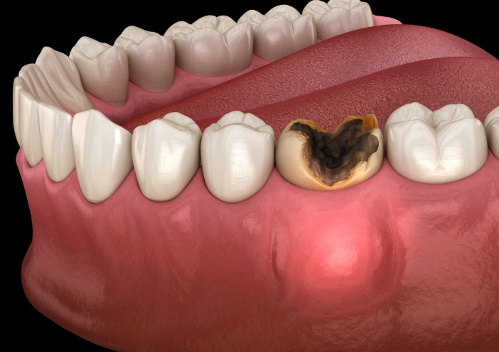 Tooth Infection to Abscess Timeline: How Long & What to Do