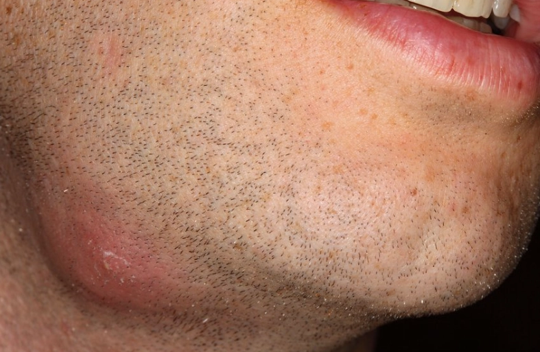 abscess root cause abscess root cause