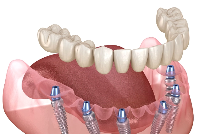 Are Full Mouth Dental Implants Worth It? An Honest Cost-Benefit Analysis