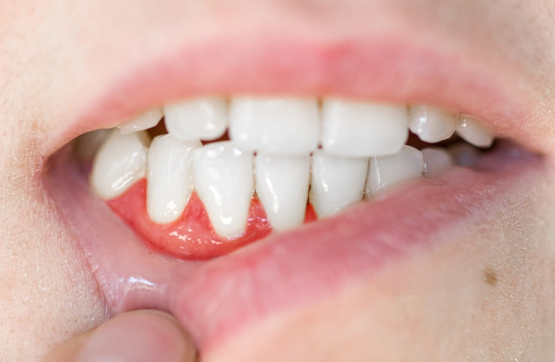 symptoms of dental abscess symptoms of dental abscess